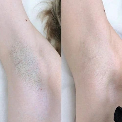 Hair Removal Mousse